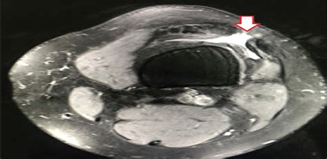 Isolated Rupture Of The Vastus Lateralis Tendon Case Report Journal