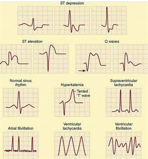 Types Of Arrhythmias MEDizzy