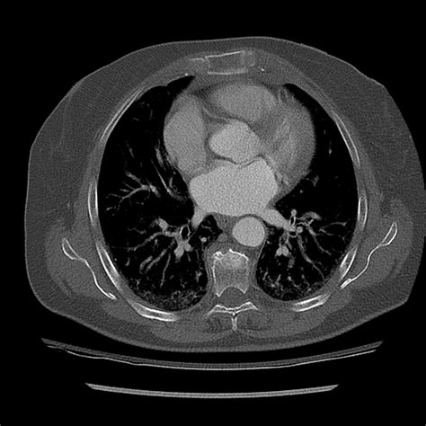 Sternal Fracture With Retrosternal Hemorrhage Image Radiopaedia Org