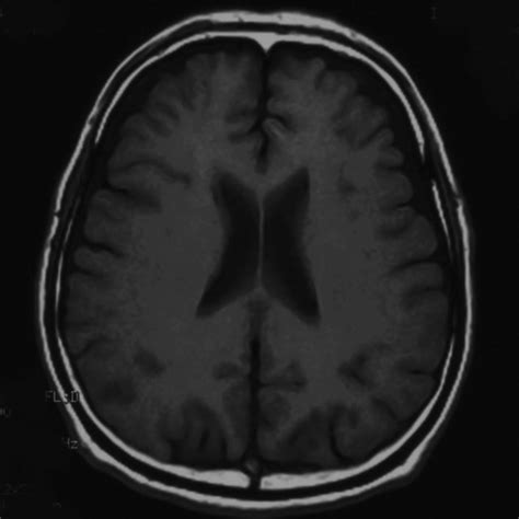 T2 Weighted Magnetic Resonance Image Old Lacunar Infarction Is Seen In Download Scientific