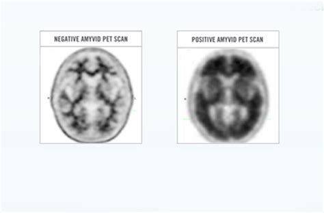 Lilly Gets Go Ahead For Alzheimers Diagnostic In Eu Pmlive