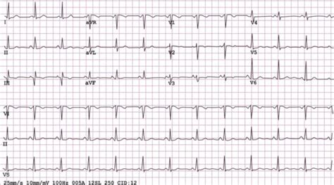 Heart Palpitations Irregular Heartbeat Explained