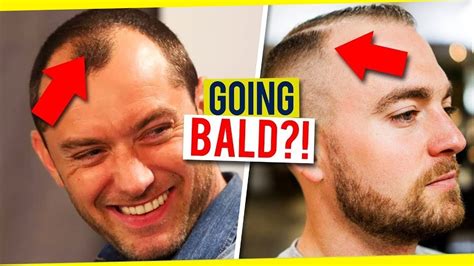 How To Tell If You Have A Receding Hairline