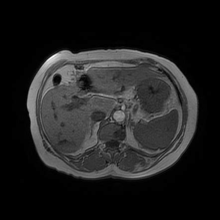 Gastrointestinal Stromal Tumor Gist Gastric Image Radiopaedia Org