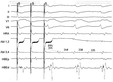 Three Dimensional Electroanatomic Maps And Entrainment Mapping From A