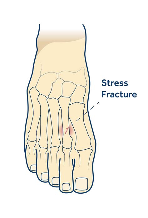 Metatarsal Bone Fracture