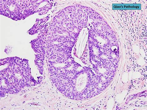 Qiaos Pathology Papillary Dcis Of The Breast A Photo On Flickriver