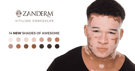 Vitiligo Makeup Camouflage & Concealer • Vitiligo Cover • Zanderm­®