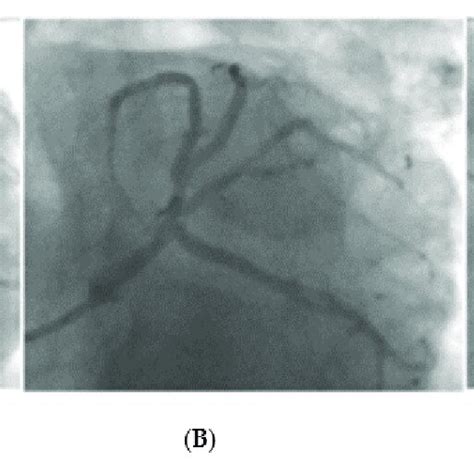 Left Main Stem PCI With DCB Image A Pre PCI Image B Immediately