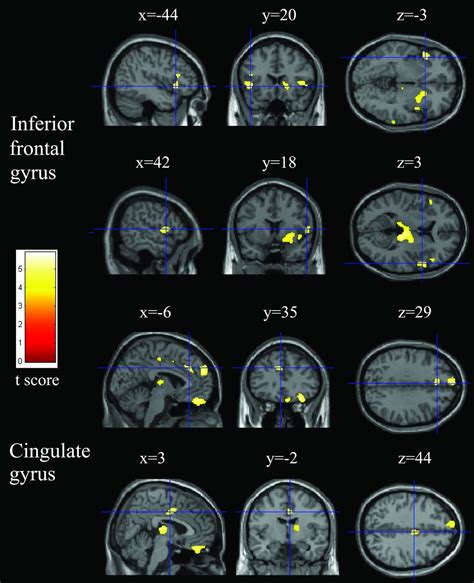 Reduced Regional Gray Matter Volume In Patients With Chronic