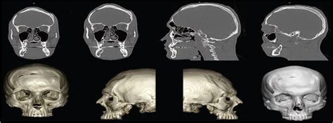 Three Dimensional Craniofacial Bone Reconstruction With Smar