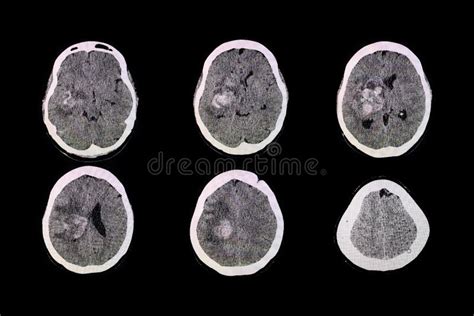 CT Brain Scan of the Patient with Basal Ganglia Hemorrhage Stock Image - Image of effect ...