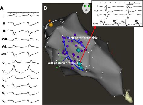 Differentiation Of Papillary Muscle From Fascicular And Mitral Annular