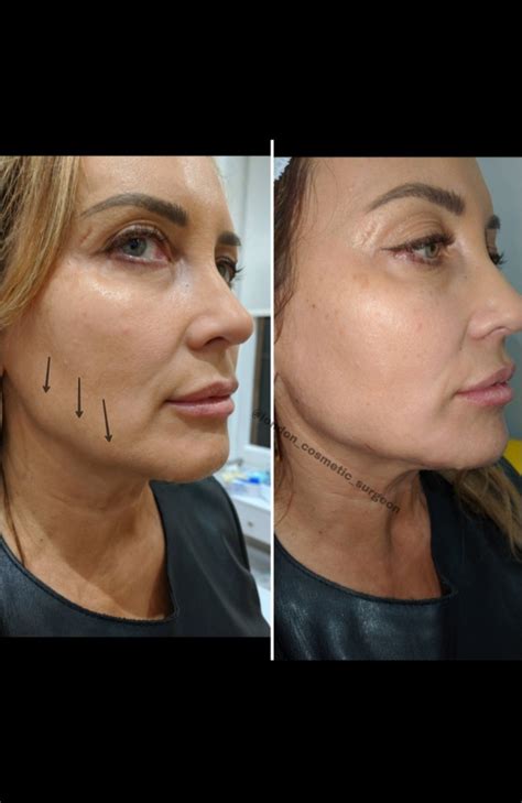 Non-Surgical Face Lift | Dr Deniz Kanliada