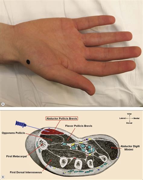 Anatomy for Needle Electromyography | Musculoskeletal Key