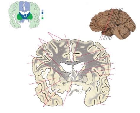 Coronal Section 5 5a Neuro Practical Diagram Quizlet