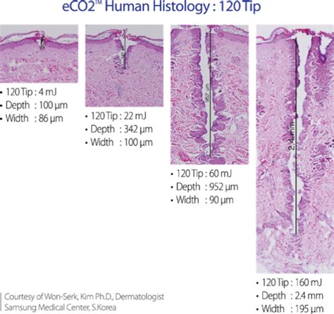 Lutronic Eco2 Laser Toronto Id Cosmetic Clinic