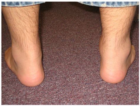 Posterior View Of Ankles Showing Swelling Of The Right Achilles Tendon Download Scientific