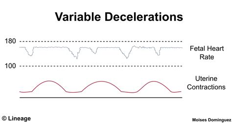 Fetal Decelerations: What Is It, Causes, And More Osmosis