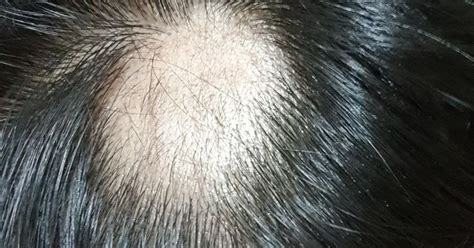 Best Ways How To Stop Alopecia Areata From Spreading