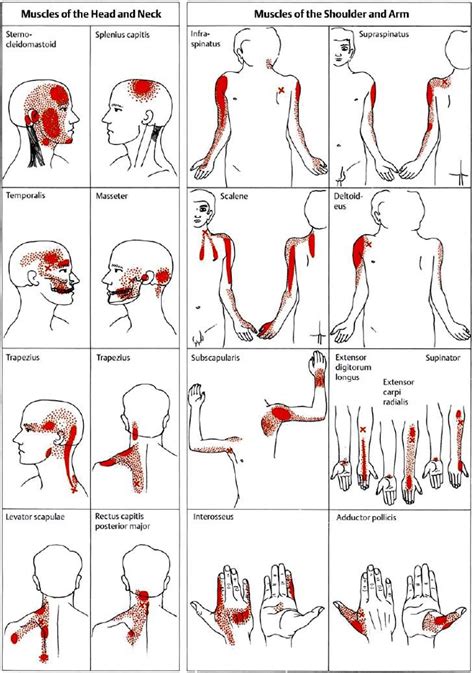 Examples Of Trigger Points And Referred Pain In The Reference Sites