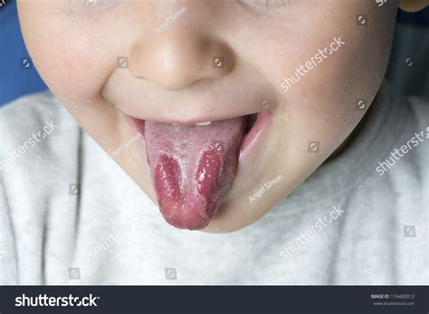 Geographic Tongue Disease Young Child Stock Photo 116400013 - Shutterstock