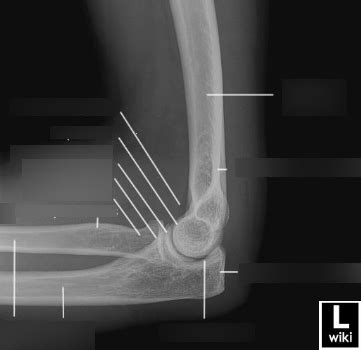 Lateral Elbow Diagram Quizlet