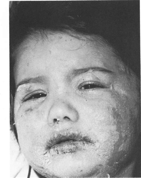 The Staphylococcal Scalded Skin Syndrome — Development Of An