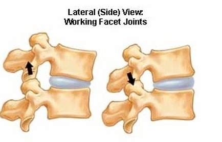 What is Facet Arthrosis? - Causes of Back Pain