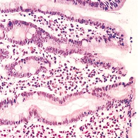 Duodenal Biopsy Specimen Showing Villous Blunting And A Dense