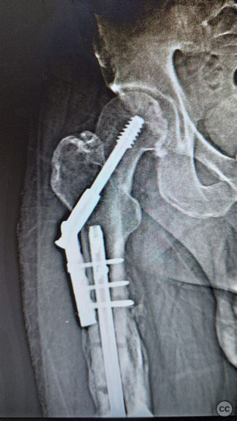 Polytrauma Femoral Shaft Basicervical And Open Tibia Fracture