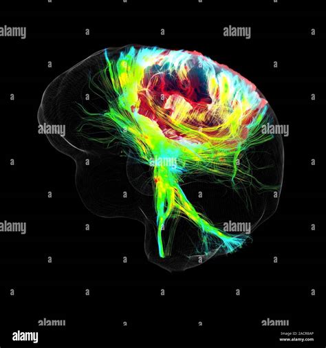 Glioblastom Gehirntumor 3D Diffusion Tensor Imaging DTI