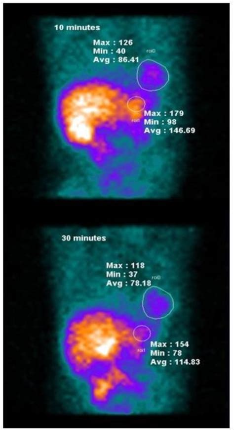 Comparison Of 99m Tc MIBI Uptake In The Target Heart And The