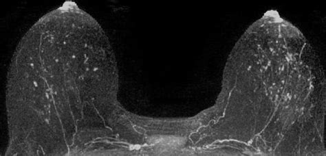 Are Qualitative Assessments Of Background Parenchymal Enhancement