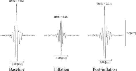 Intracardiac High Frequency QRS Signals Recorded At Three Stages I