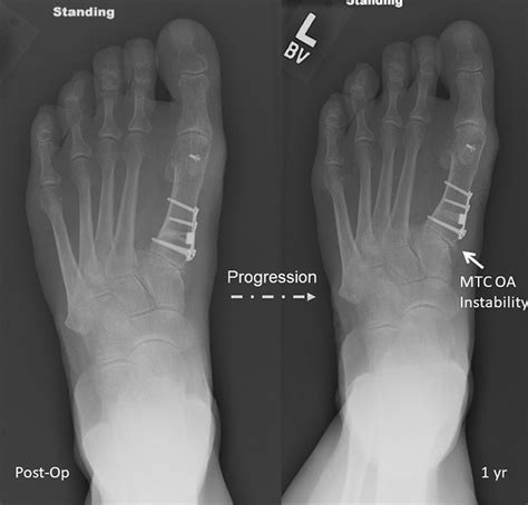 Medial Cuneiform Opening Wedge Osteotomy For The Treatment Of Hallux