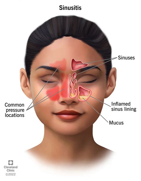 Understanding Sinus Infections Are They Contagious Flash Uganda Media