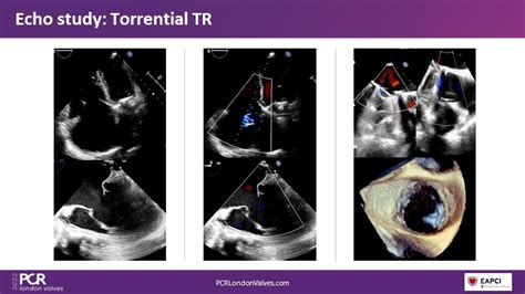 The Right Valves For The Right Ventricle Venus Medtech Tricuspid And