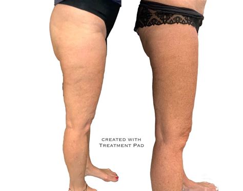 Body Contouring With Venus Freeze Plus Fraser Medical Aesthetics