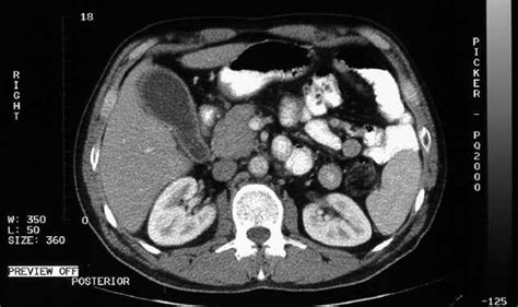 Tomografía De Abdomen Y Pelvis