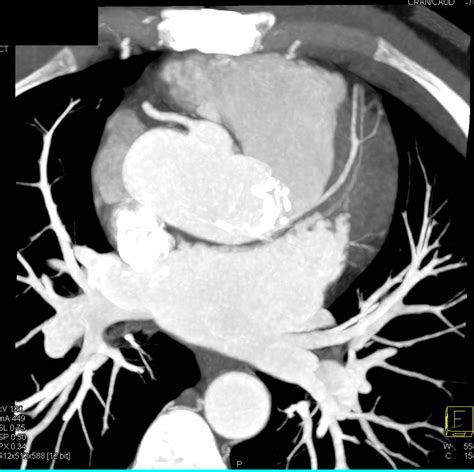 Aortic Dissection Involved The Right Innominate Artery Chest Case