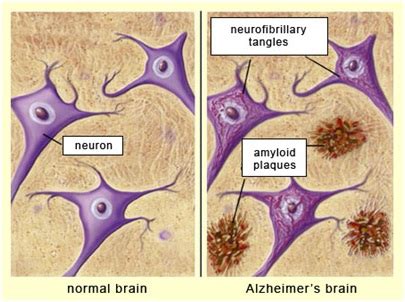 Curcumins Role As An Anti Neurofibrillary Agent Towards Alzheimer S