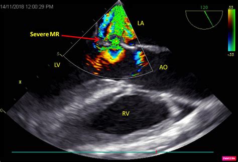 Transesophageal Echocardiography Showing Perforation Of Anterior