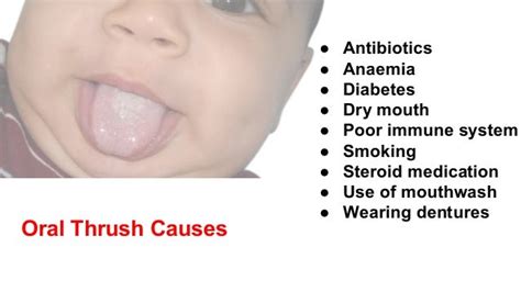 Causes Of Oral Thrush In Adults - photographyrevizion