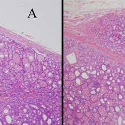 Minimally Invasive Encapsulated Angioinvasive Follicular Thyroid