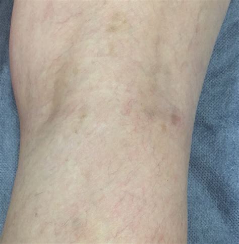 Spider Vein Treatment Brisbane Results — The Leg Vein Doctor Brisbane