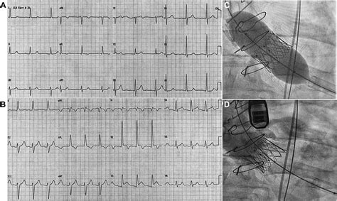 Left Septal Fascicular Block Evidence Causes And Diagnostic Criteria