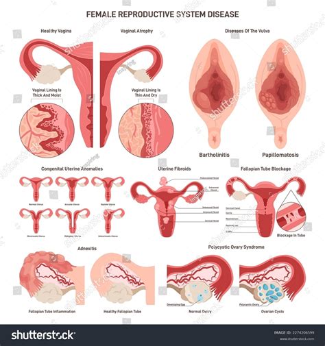 Female Reproductive System Disorder Set Royalty Free Stock Vector