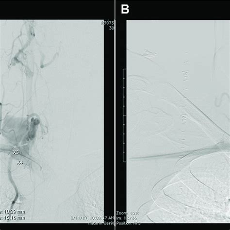 A The Arteriogram Before Treatment Demonstrates The Arteriovenous