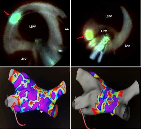 Lspv Left Superior Pulmonary Vein Lipv Left Inferior Pulmonary Vein